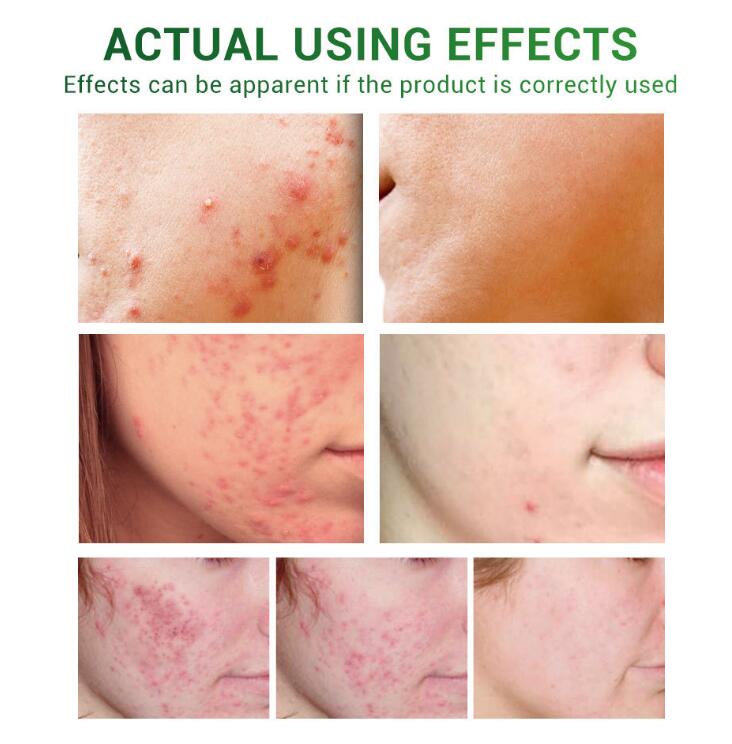 Acne Treatment Serum Facial Essence Repair Oil